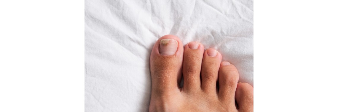 Onicomicosi: come curare la micosi alle unghie con rimedi naturali